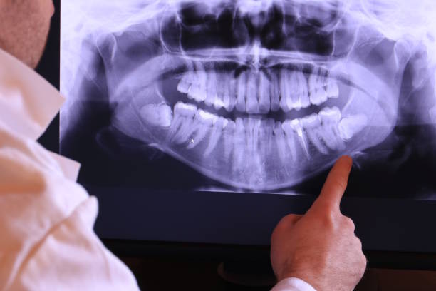 Best Emergency Wisdom Teeth Removal in Montpelier, VT